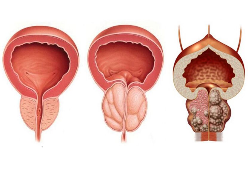 Stänn vun der Prostatitis an de Besoin fir voller Prostavit ze benotzen