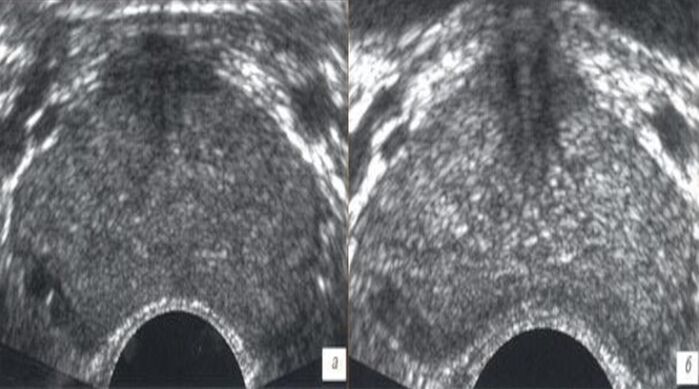 Ultraschall virun an no der Behandlung mat Drëpsen zxcvbncwert